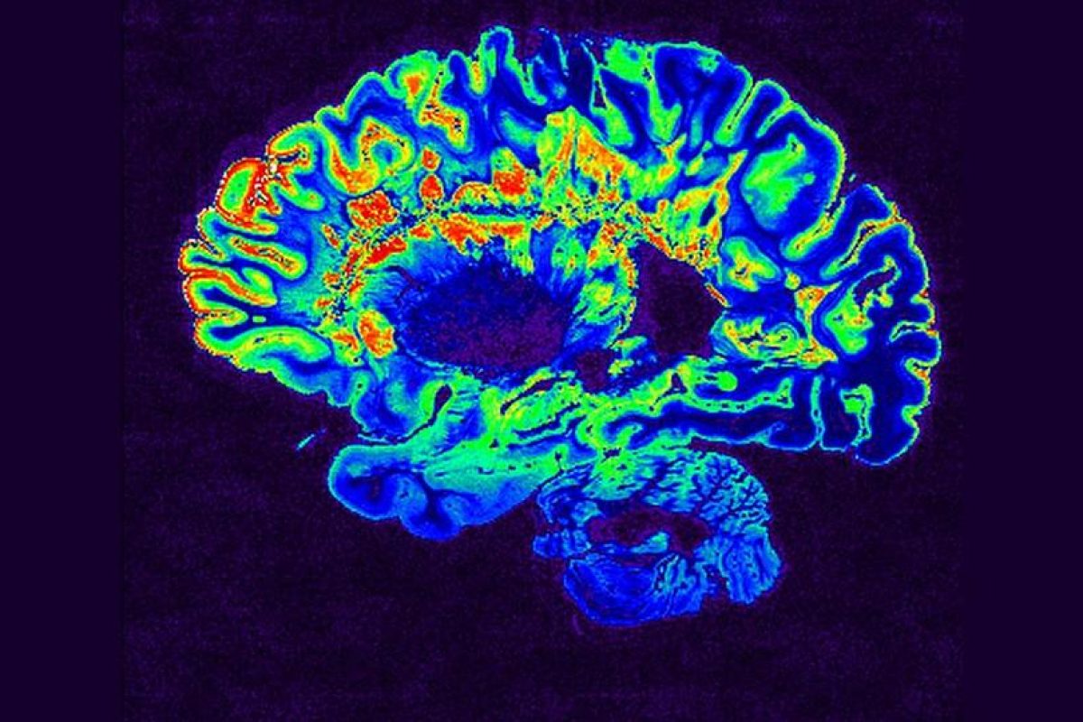 Tipping the Balance’ of Immune Cells From Bad to Good Reverses Multiple Sclerosis Symptoms in Mice